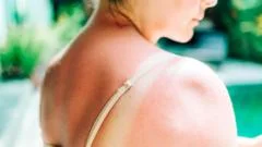 Surge in High-Risk Skin Cancer Cases Reaches Record Levels in the UK