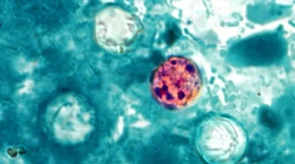 Exposure to the cyclospora parasite leads to cyclosporiasis, a stomach bug that can cause explosive diarrhea