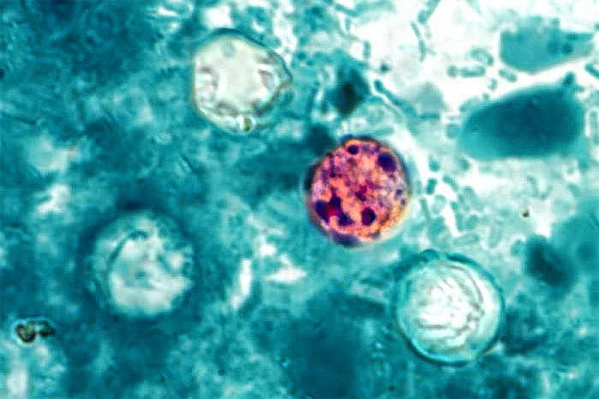 The microscopic parasite cyclospora , seen here, is spread by humans. But it’s hard to track because it cannot be traced using advanced testing methods