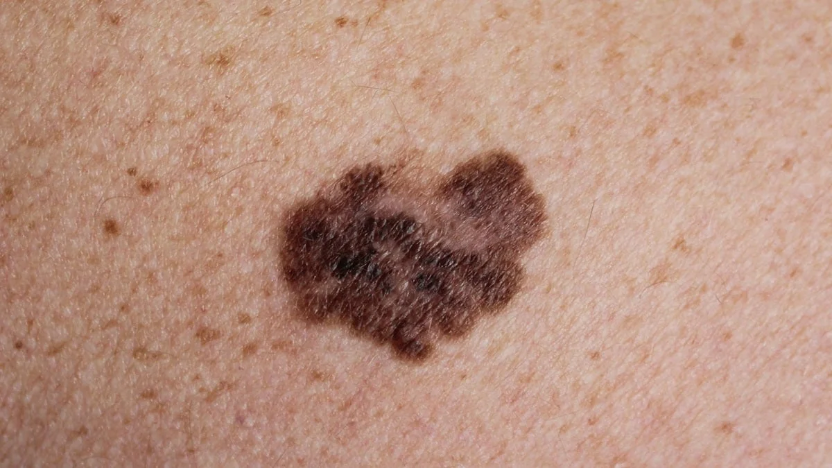 Melanoma is the most deadly form of skin cancer